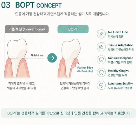BOPT 참고 도해 — 기존 보철의 Finish Line 과 BOPT 의 Feather Edge 비교